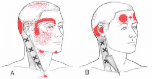 sindrome-cervicale-di-barrè-lieou4