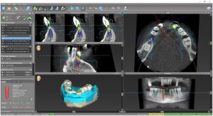 implantologia-computer-guidata